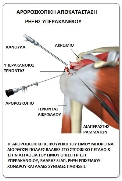 arthroscopic surgery of the rotator cuff 3 Παυλίδης Ι.